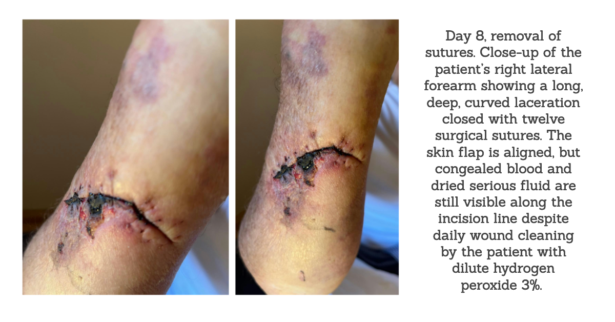 DAY 8 WOUND
